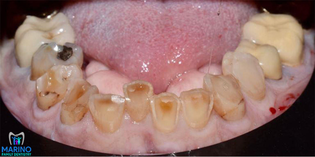 Tooth Colored Fillings Greater Jacksonville Florida Dentist