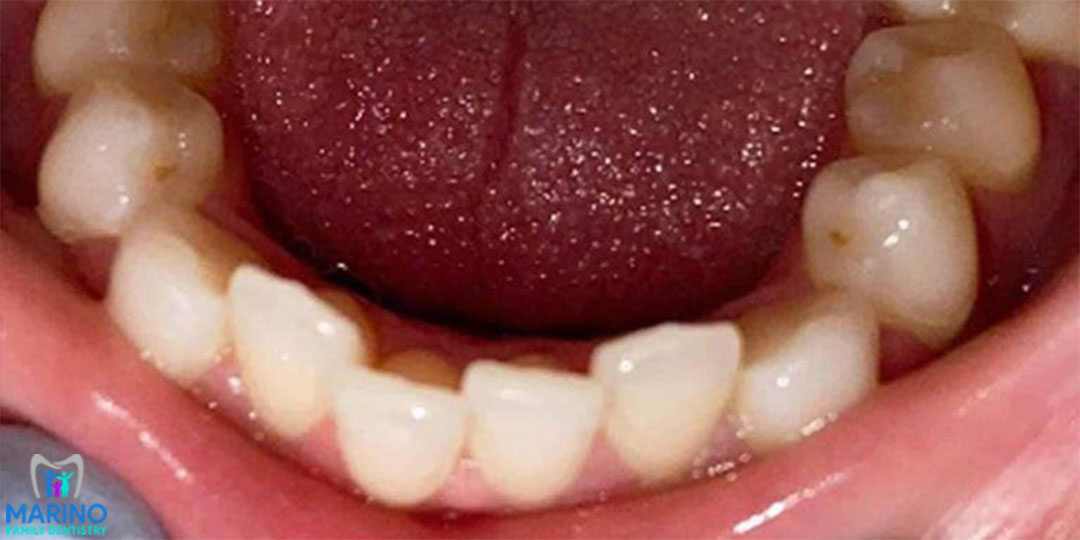 Tooth Restoration Dentist In Greater Jacksonville Florida